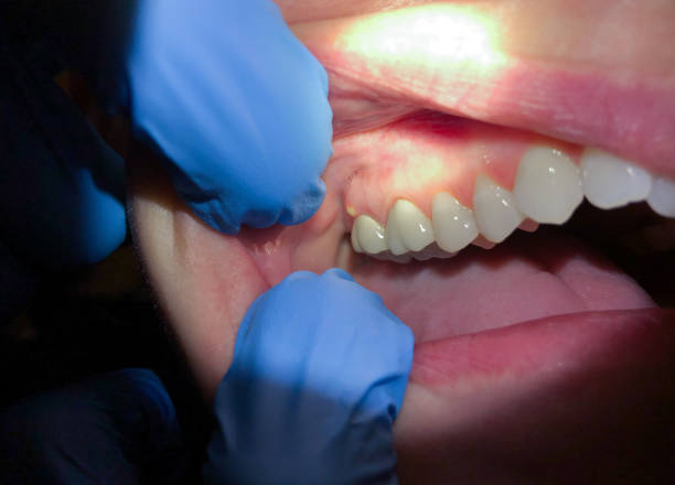Best Emergency Dental Filling Replacement  in Fort Montgomery, NY